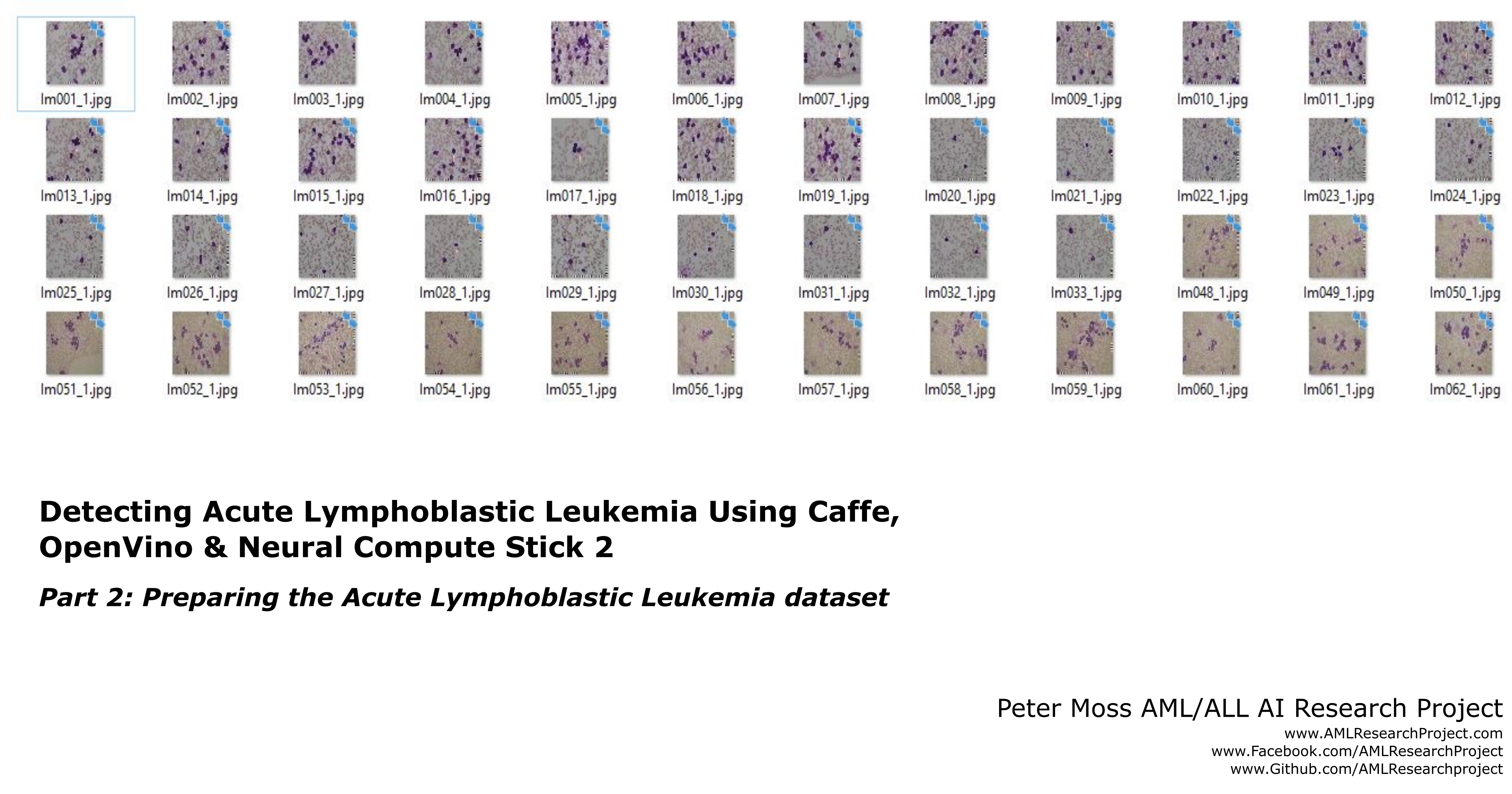 Detecting Acute Lymphoblastic Leukemia Using Caffe, OpenVino & Neural Compute Stick 2: Part 2 Preparing the Acute Lymphoblastic Leukemia dataset
